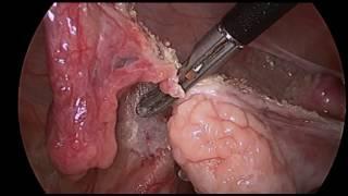 Laparoscopic Salpingectomy Revised FINAL