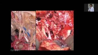 Management of cavernous sinus Meningioma in the era of Radiosurgery