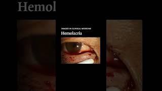 Hemolacria | NEJM