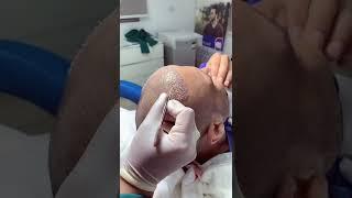 كيف تتم زراعة الشعر #زراعة_الشعر