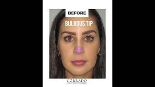 Rhinoplasty Before and After Pictures | Dr. Anthony Corrado