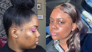 THE REAL SKIN CARE ROUTINE | Getting Rid Of Dark Spots and Pimples