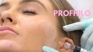 Profhilo Before And After Face  Profhilo Treatment by Dr Nina Bal Facial Sculpting 