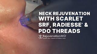 Scarlet SRF, PDO Threads, and RADIESSE | Explore Non-Surgical Neck Lift Options