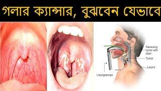 গলার ক্যান্সার, বুঝবেন যেভাবে ||Throat cancer, understand how to ||  Health Tips Ltd