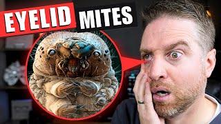 How to Get Rid Of Eyelid Mites That Cause Demodex Blepharitis!