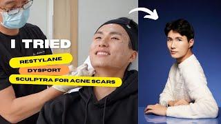 2023 ACNE SCAR UPDATE | non-invasive “plastic surgery”? Before & After 
