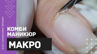 МАКРО комби маникюр Коррекция КЛЮЮЩЕГО ногтя акригелем  Геометрический маникюр 2020