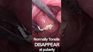 Squeezing infected tonsils