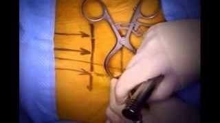 Far Lateral Disc Herniation | Minimally Invasive Surgical Removal | Spine Specialist Colorado