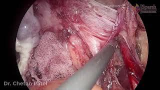 ENDOMETRIOSIS SURGERY  LAPAROSCOPIC HYSTERECTOMY