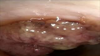 REctal carcinoma   in dog ESD