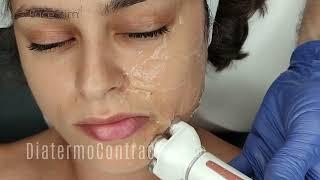 FaceStim by JOVEVA - Face Stimulation Treatment of Inner Muscles