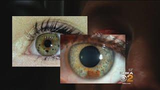 New Study Looks At Possible Relationship Between Eye Freckles And Melanoma