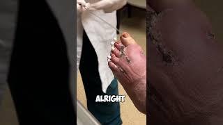 Simple pin removal from patients toes! Watch what happens!