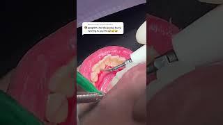 Scaling to remove plaque and tartar | Scaling buang plak dan karang gigi