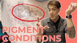 What is Dermal Melanocytosis? AKA Hori's Naevus | Dr Davin Lim