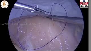 Laparoscopic  suturing : Quick learning in Five minutes