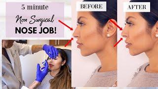 Non-surgical Rhinoplasty vlog |  5 Minute Nose Job | Jessica Giselle