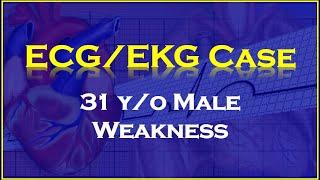 ECG/EKG Case: 31 y/o Male with General Weakness