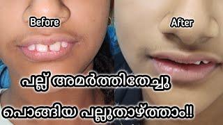 പല്ല് അമർത്തി തേച്ചുപല്ല് താഴ്ത്താമോ | Dentaltalk malayalam By Dr Ajina Salim #drajinasalim #ortho