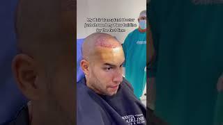 #hairtransplant done in Colombia #bogotahairlines #transplantecapilar #fuehairtransplant