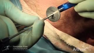 All Inside ACL Reconstruction using the Translateral Technique - Hampshire Knee