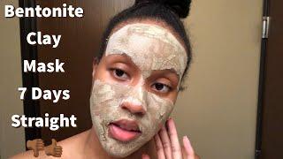 I Tried Aztec Healing Clay for 7 days Straight on My Acne  | Full Before and After Review