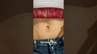 What Causes An Outie Belly Button? 