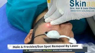 Sun Spots Removal Treatment by Nd Yag Q-Switched Laser