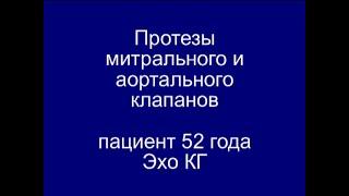 Протезы Митрального и Аортального клапанов. Эхо - Кг.