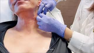 See Dr. Jafari performing non-surgical neck lift using PDO threads