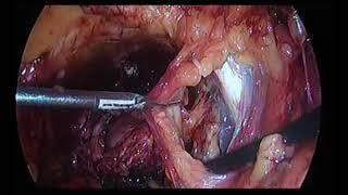 laparoskopowa przedotrzewnowa prostatektomia radykalna - laparoscopic extraperitoneal  prostatectomy