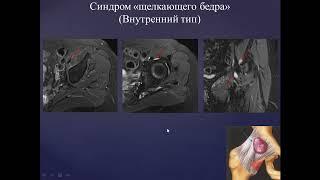 Базовый курс по МРТ  Лекция «МР семиотика повреждений тазобедренного сустава»  Лектор  Учеваткин №3