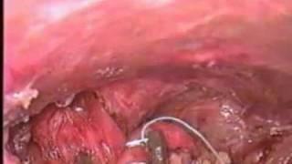 Hernia Hiatal sin malla - Dr Alonso Alvarado