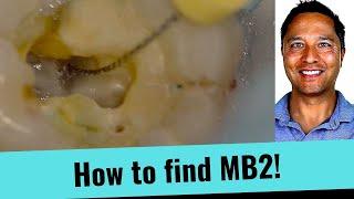 Live!  Root Canal - How to the find MB2 Canal (Simple Tips)