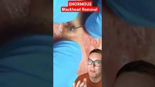 ENORMOUS EAR BLACKHEAD REMOVAL - Be Warned #shorts