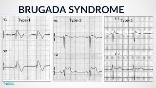 Brugada Syndrome - Pathology, Types, Diagnosis & Management