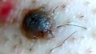 Back Blackhead Extraction Session #2 in "Mrs Gold"-Addressing the Inflamed One