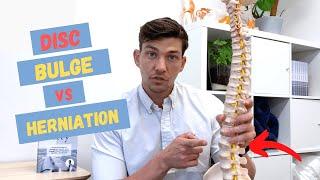 Bulging Disc vs Herniated Disc – What's the Difference?