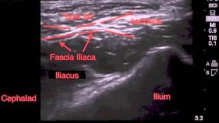 Ultrasound Guided Fascia Illiaca Block Tutorial - SSRAUSA.com