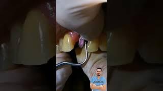 Dental implants||Зубные имплантаты||치과 임플란트||Cấy ghép nha khoa||दंत्य प्रतिस्थापन#dr_abdullah_sultan