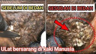 FOBIA. LARVA JIGGER BERSARANG DI KAKI MANUSIA HIDUP.