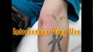 Intravenous Drug Use