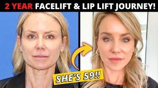 59 Year Old's 2 Year Facelift and Lip Lift Journey (her entire post-op recovery!)