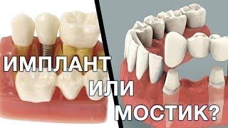 Имплант или зубной мостик. Что лучше выбрать? Имплантация зубов. Мост зубной.