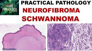 NEUROFIBROMA AND SCHWANNOMA: Clinical features & Morphology