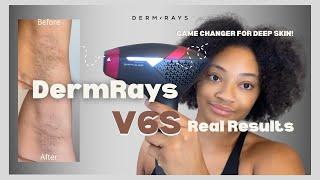 The Best At-Home Laser Hair Removal for Darker Skin | DermRays