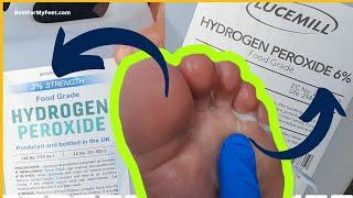 3% vs 6% Hydrogen Peroxide For Athlete Foot Fungus (Which One Works?)