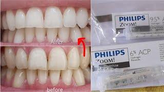 Philips Zoom Teeth Whitening | 14 days - really works!
